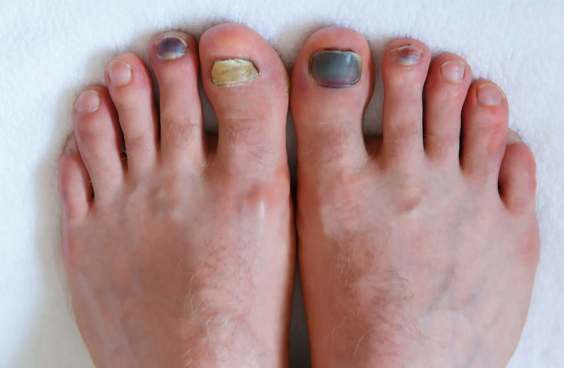 Toenail fungus condition before treatment
